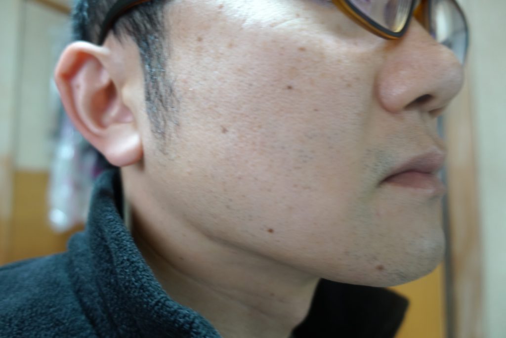 ヒゲ脱毛8回目施術前-側面(左)