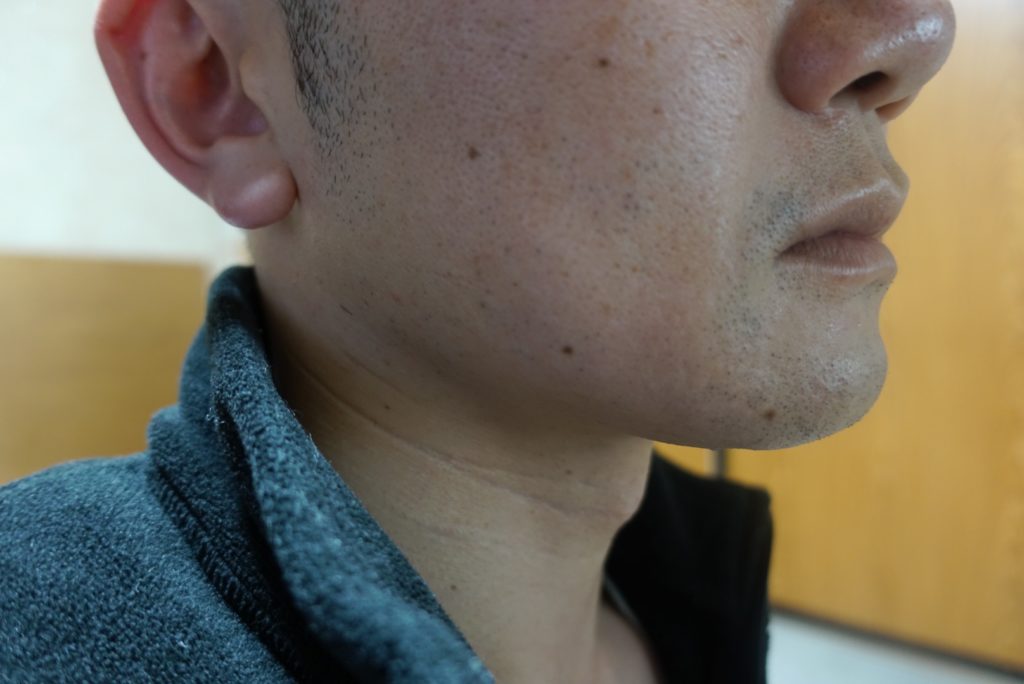 ヒゲ脱毛8回目施術3日後-側面(左)