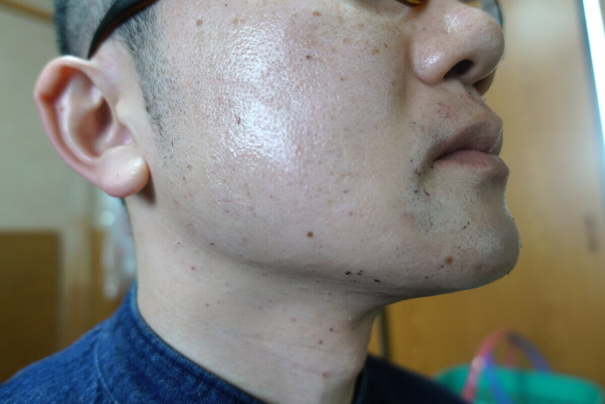 ヒゲ脱毛9回目施術直後-側面(左)