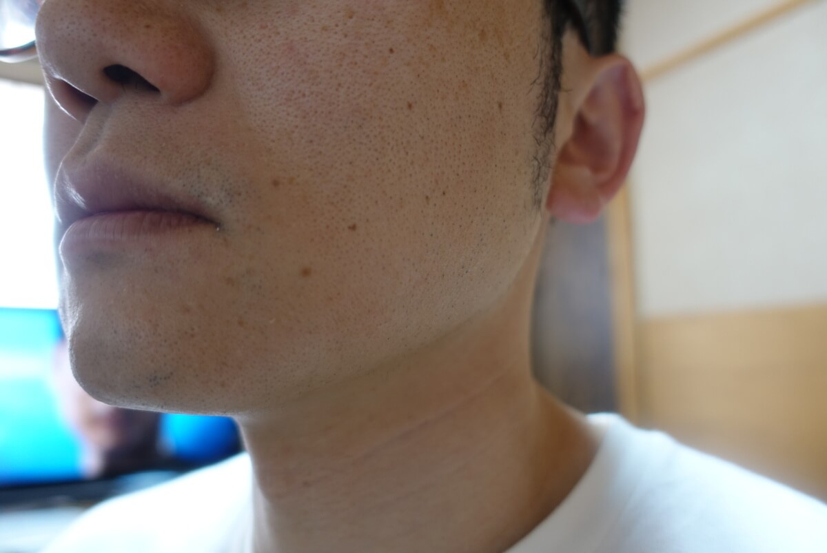ヒゲ脱毛10回目施術前-側面(左)