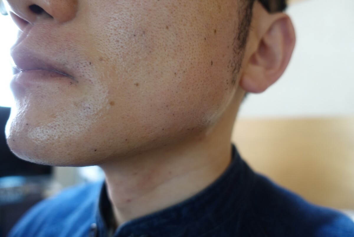 ヒゲ脱毛10回目施術直後-側面(左)