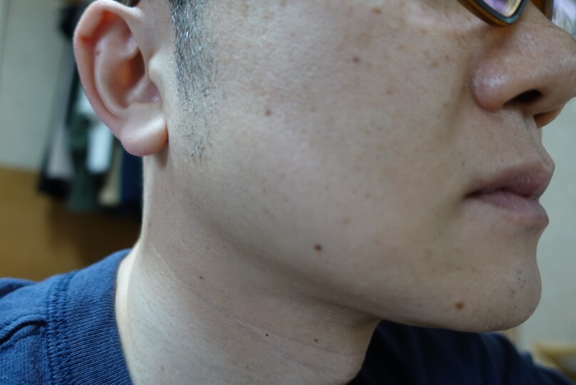 メンズリゼでヒゲ脱毛12回目施術前-側面(右)