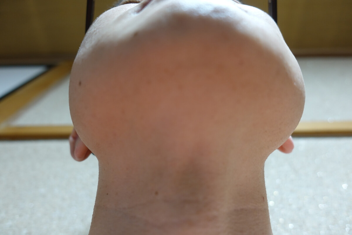 メンズリゼでヒゲ脱毛15回目施術1ヵ月後-あご下